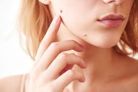 Moles in Astrology